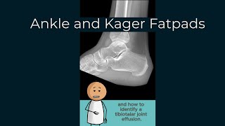 The Kager Fat Pad and Tibiotalar joint effusion [upl. by Alekin849]