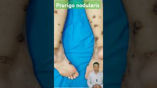 PRURIGO NODULARIS शरीर पर खुजली और गांठें  dryskin itching nodules shortsfeed ytshorts short [upl. by Amice]