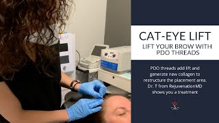 NonSurgical Brow and Eye lift with PDO Threads [upl. by Nollie962]