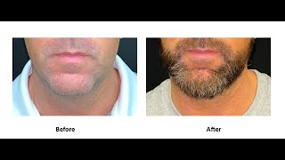 Chin Augmentation performed by Mr Shailesh Vadodaria under local anaesthetics and sedation [upl. by Gherlein]