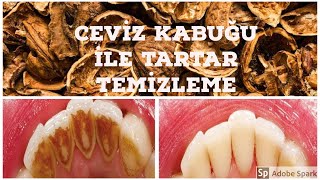 TARTAR TEMİZLEME CEVİZ KABUĞU İLE DİŞ TARTARI TEMİZLEME [upl. by Eihpos463]