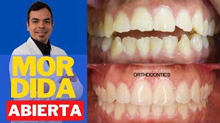 📣 MORDIDA ABIERTA ANTES Y DESPUÉS 🤩  TESTIMONIO  CAMBIOS EN EL PERFIL FACIAL [upl. by Pond]