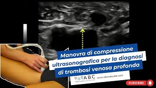 Manovra di compressione ultrasonografica per la diagnosi di trombosi venosa profonda CUS [upl. by Dolf306]