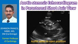 Aortic stenosis Echocardiogram in parasternal short axis view [upl. by Nimrahc]