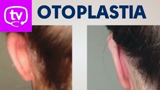 Otoplastia la solución para corregir las orejas de soplillo [upl. by Treboh]