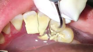 Houston Cosmetic DentistTartar Tartar Tartar How we remove it [upl. by Mcclees381]