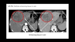 3 LIRADS Overview of CTMR algorithm and major features  Part 1 By Dr Victoria Chernyak [upl. by Thesda289]