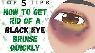 How To Get Rid Of A Black Eye Bruise Quickly  Black Eye Cover Up [upl. by Fair]