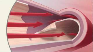 SCAD Spontaneous Coronary Artery Dissection  Mayo Clinic [upl. by Freeborn]