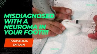 Misdiagnosed with a Neuroma in your foot neuroma balloffootpain [upl. by Skrap250]