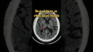 Acute Infarct Brain Radiology [upl. by Riay537]