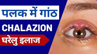 आंख की पलक में गांठ Chalazion  लक्षण कारण घरेलु उपचार [upl. by Islean]