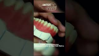 festoneado de protesis total en unos dias se libera en formato tutorial shorts dentadura [upl. by Dennie372]