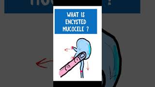 ENCYSTED MUCOCELE  Chronic dacryocystitis opthalmology [upl. by Akila]