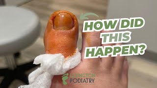 Partial TOENAIL Removal [upl. by Mirella]