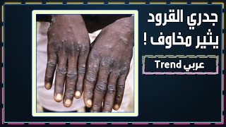 جدري القرود مر تبط بالمثـــلـــيـة؟ فيروس ينتشر ويثير تساؤلات [upl. by Shenan825]