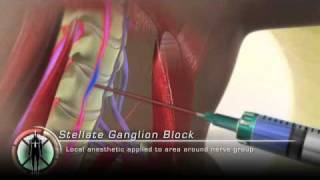 Stellate Ganglion Block Injection [upl. by Okimik7]