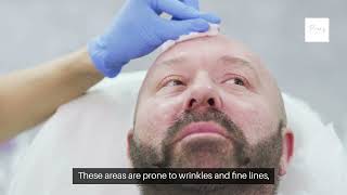 Brotox Explained Get Rid of Wrinkles Fast in prospertx littleelmtx [upl. by Platt839]