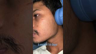 minoxidil minoxidil beard growth  2 month minoxidil beard  mintop [upl. by Koenig]