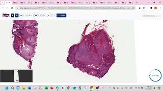 Cellular neurothekeoma and follicular neoplasm neurofibroma [upl. by Yeknarf533]