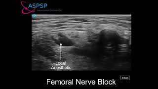 Ultrasound Guided Femoral Nerve Block In a Patient With Vascular Stent [upl. by Jezabella544]