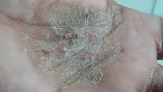 Palmar Keratoderma Shocked to read its incurable [upl. by Alberic]