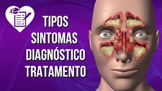 SINUSITE  Causas Sintomas e Tratamento [upl. by Innad961]