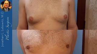 3 Months PostOp❗Gynecomastia Surgery At The Long Island VaserLipo Center By Dr Lebowitz [upl. by Ahsemed]