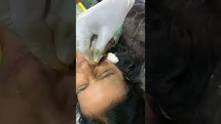 रक्त मोक्षणleech therapyayurvedic treatment for skin acne bams bamslecture ayurvedictreatment [upl. by Fabiano53]