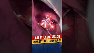 Latest Lasik Vision Correction Technology [upl. by Koerlin]