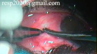 Conjunctival Graft Suturing For Pterygium Excision With Autograft By Dr Sudhir Singh 33 [upl. by Ailen675]