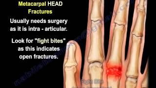 Metacarpal Fractures  Everything You Need To Know  Dr Nabil Ebraheim [upl. by Philine884]