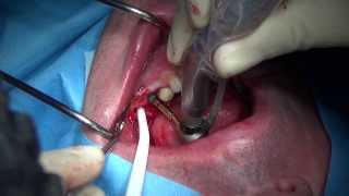 Immediate implant placement in mandibular molar extraction socket [upl. by Septima154]