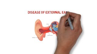 Diseases of external ear  trauma  inflammatory  neoplastic disorders2 [upl. by Edivad]