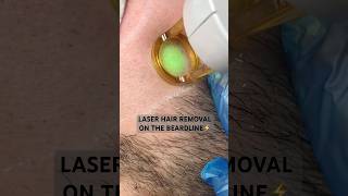 Laser hair removal on the beardline ⚡️ [upl. by England]