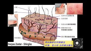 《自然療法與你》 EP675  帶狀皰疹的同類療法 [upl. by Odell]