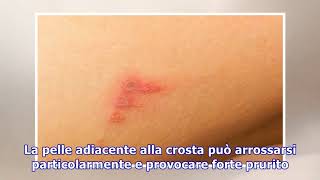 Impetigine come si prende e come si cura questa patologia della pelle [upl. by Ehav373]