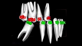 Uprighting molars with the Straight wire system part 1 [upl. by Gaddi]