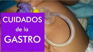 Gastrostomía  Lavado de sonda y como evitar taponamientos [upl. by Kliment542]