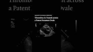 Thrombus in Transit across a Patent Foramen Ovale  NEJM [upl. by Ennasirk46]