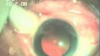 Intravitreal Injection Avastin In WET AMD Dr Sudhalkar [upl. by Swope]