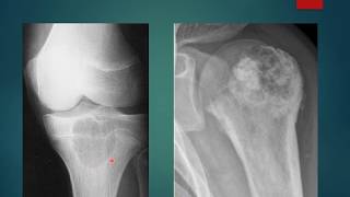 Chondroblastoma case presentation short [upl. by Darbee]