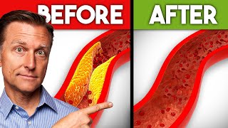 Best Nutrients to Remove Plaque from Arteries [upl. by Aved631]