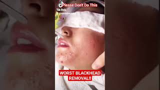 ❌ Worst BLACKHEAD REMOVAL Technique shorts [upl. by Thurnau]