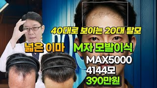 모발이식비용 이마축소 M자탈모 모발이식 MAX5000 4144모 이식 390만원한시적 [upl. by Esertap]