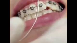 How to use Dental Floss Threader [upl. by Koenraad]