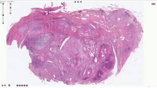 Hashimoto Thyroiditis  Histopathology [upl. by Inilahs853]