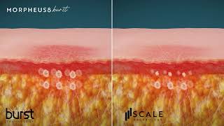 Morpheus8 Burst amp Scale [upl. by Donough419]