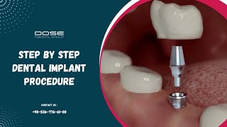 Step by Step Dental Implant Procedure [upl. by Arahs531]