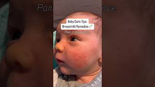 New born care tips  acne solution baby parentingtips momhacks [upl. by Eentruoc]